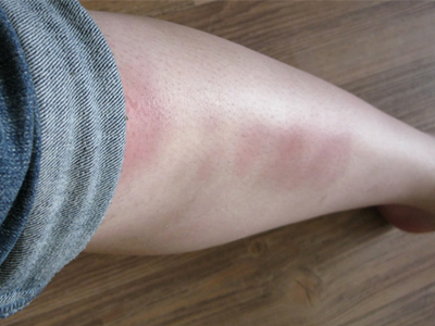 Swelling or Bruising